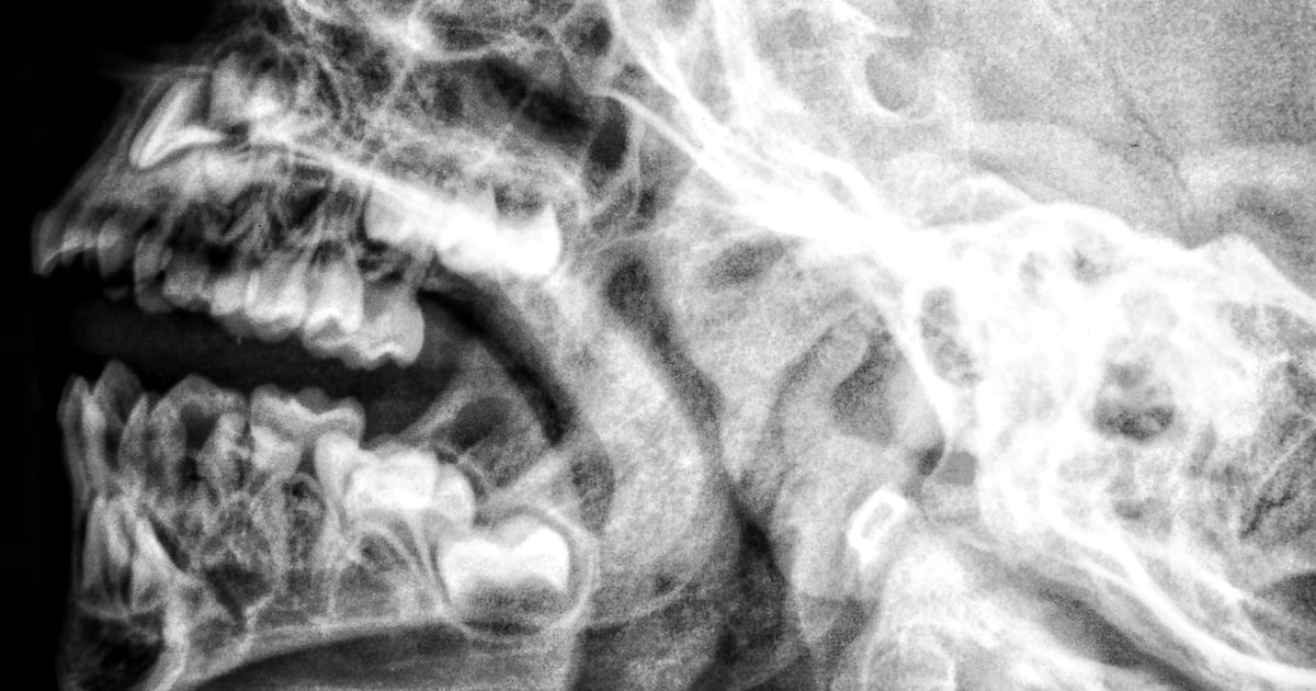 Concussion or Something Worse? Recognizing Traumatic Brain Injury After a Cleveland Car Accident