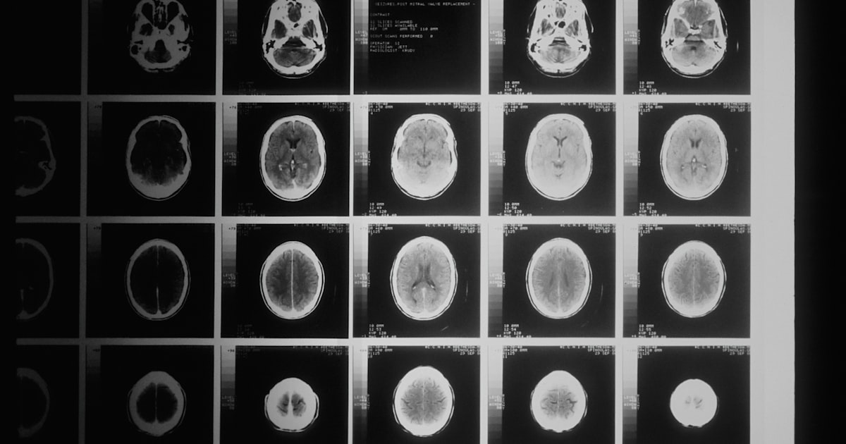 Cleveland emergency room where summer traumatic brain injuries are treated